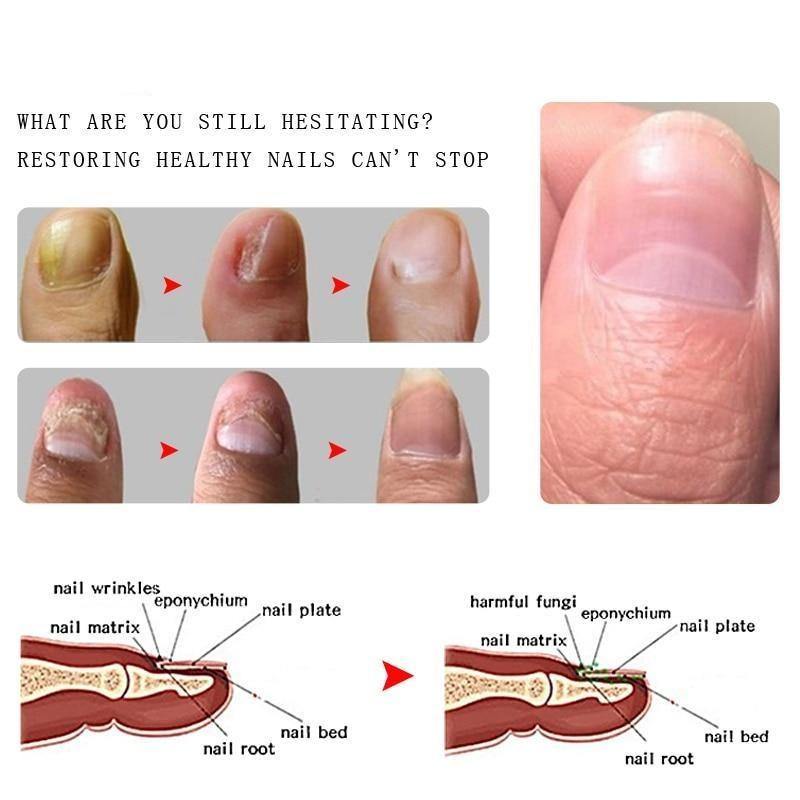 Óleo Anti-Bacteriano e Anti-Micótico para Unhas - RtopR®